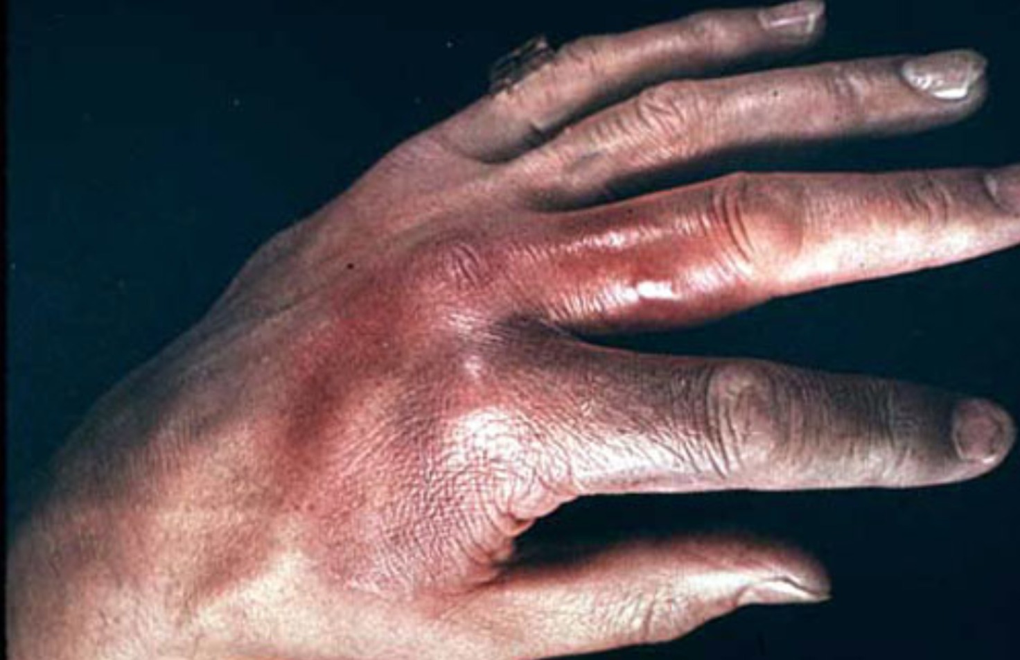 丹毒・蜂窩織炎（たんどく・ほうかしきえん）｜おおふな皮ふ科の皮膚科診察案内